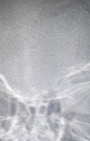 Adult Cochlear Implantation: A Rising Tide of Hope Adult Cochlear Implantation: A Rising Tide of Hope